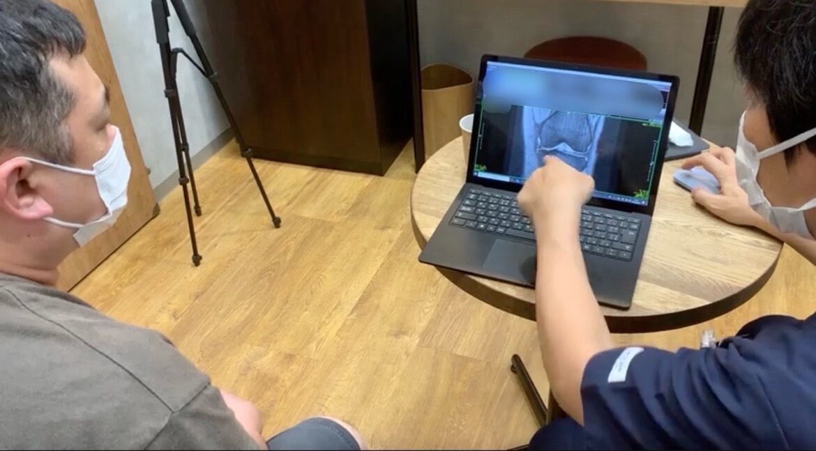 左半月板損傷　幹細胞治療