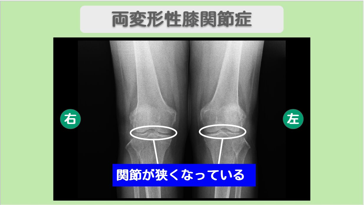両変形性膝関節症　幹細胞治療　