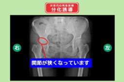 右変形性関節症　部な誘導　幹細胞治療