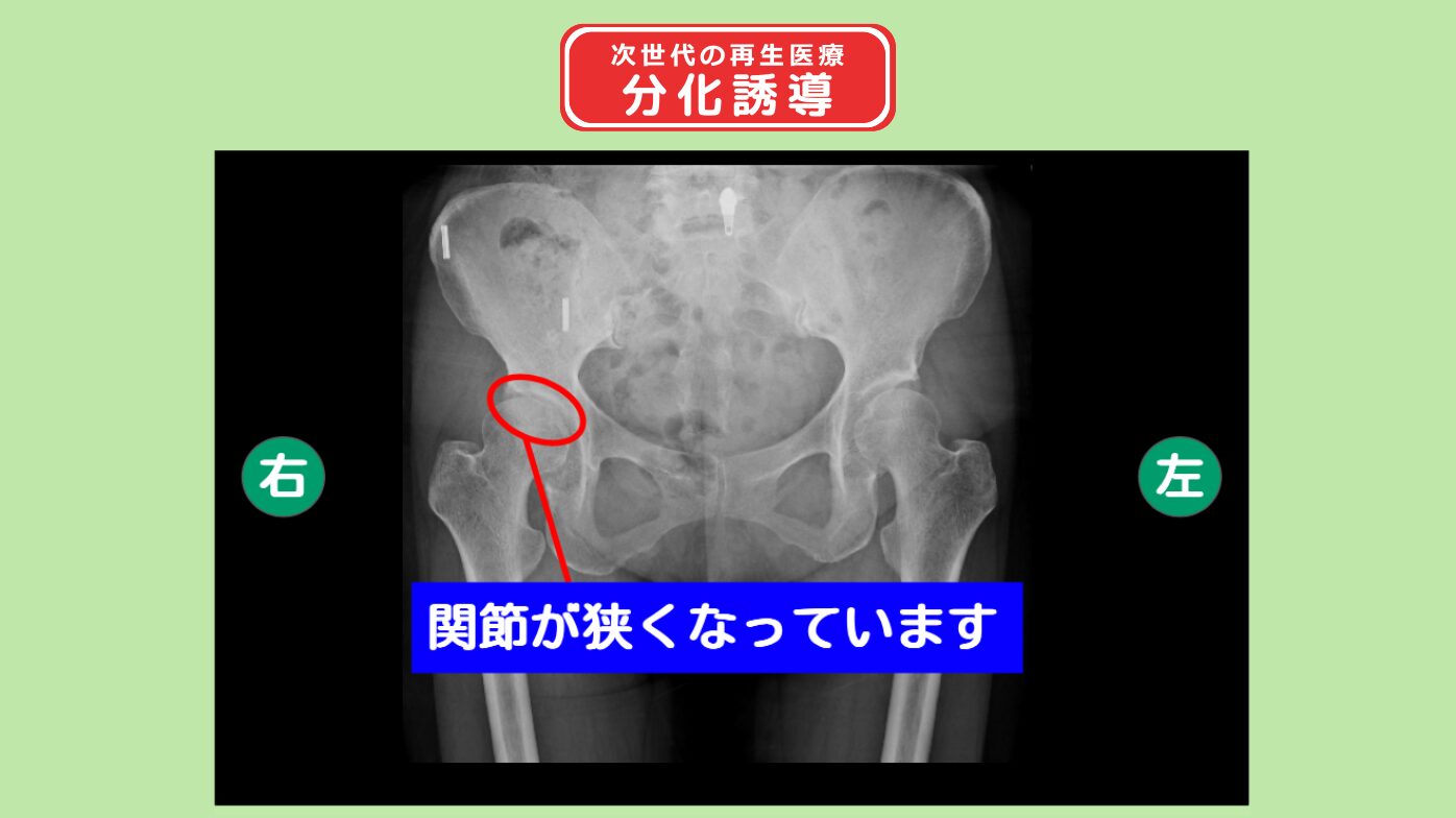 右変形性関節症 部な誘導 幹細胞治療