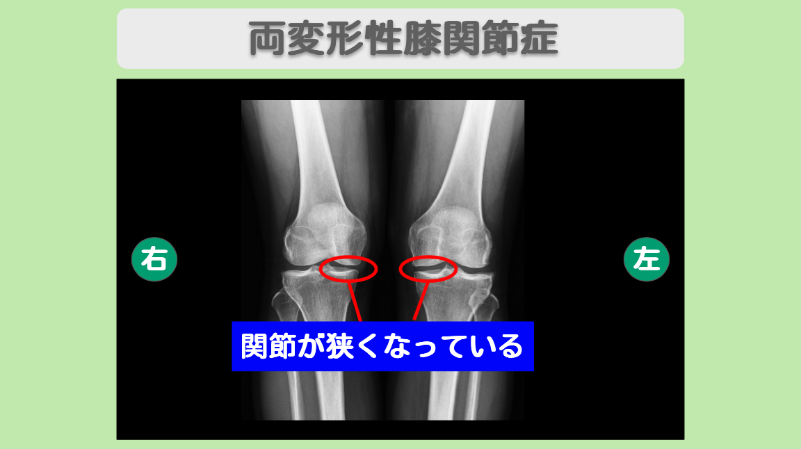 両膝変形性関節症　幹細胞治療