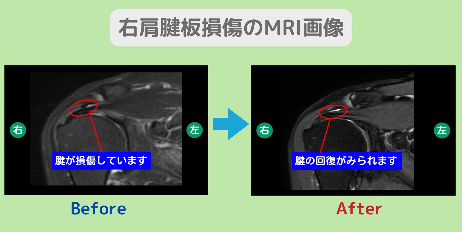 右肩腱板損傷　幹細胞治療
