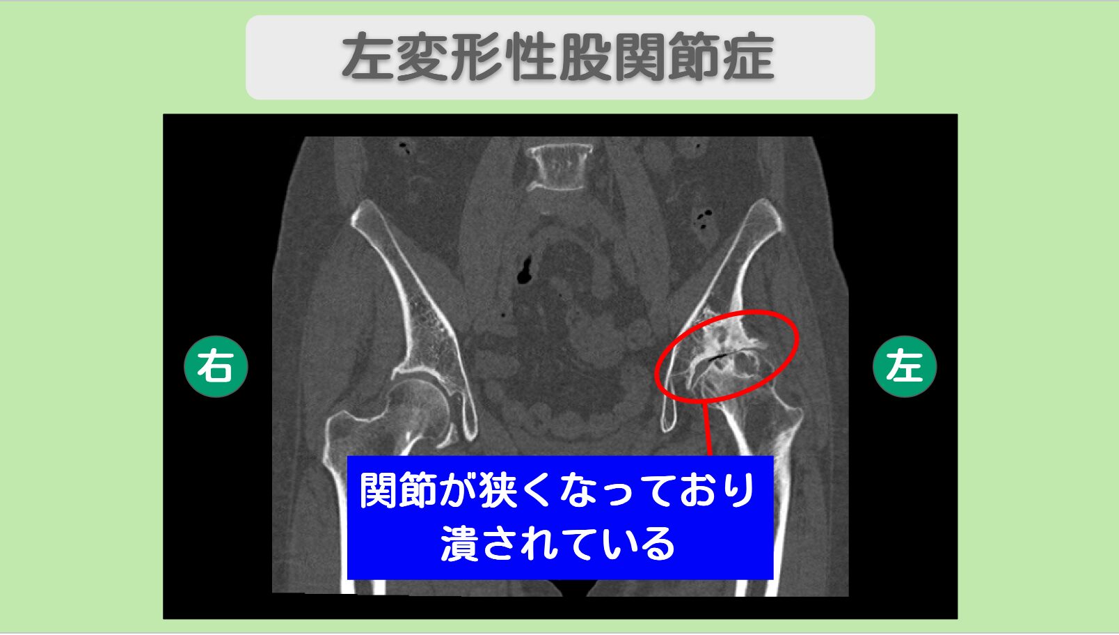 左変形性股関節症　幹細胞治療