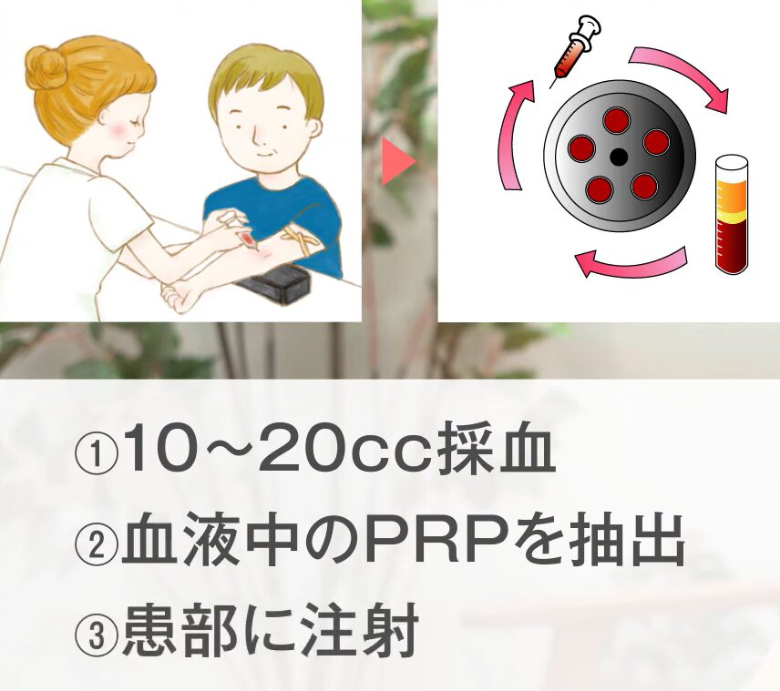 PRP治療