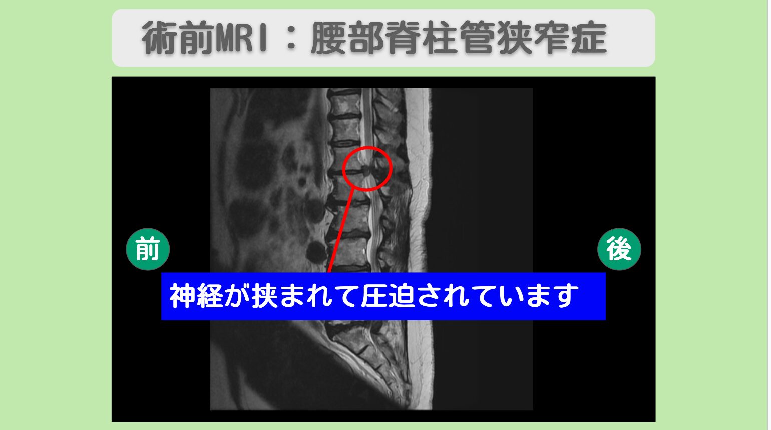 腰部脊柱管狭窄症術後　幹細胞治療　60代女性　