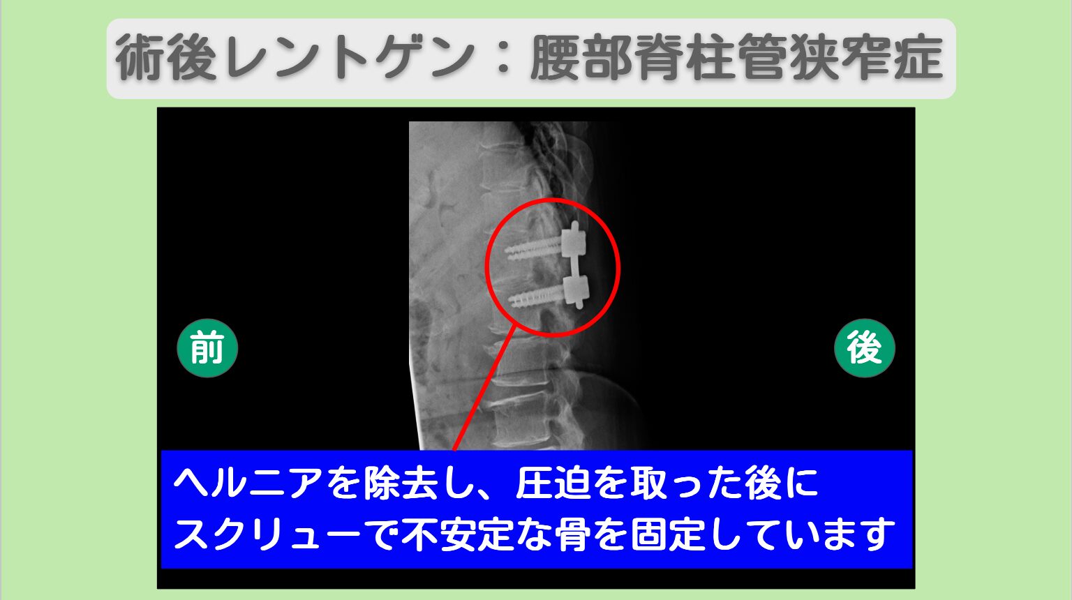 腰部脊柱管狭窄症術後　幹細胞治療