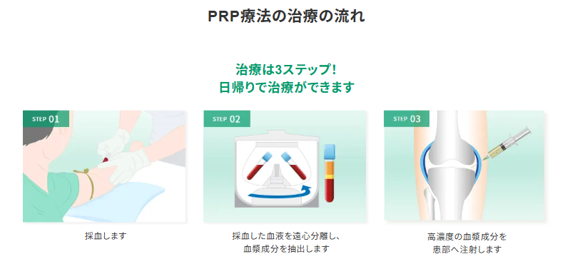 PRP療法の治療の流れ