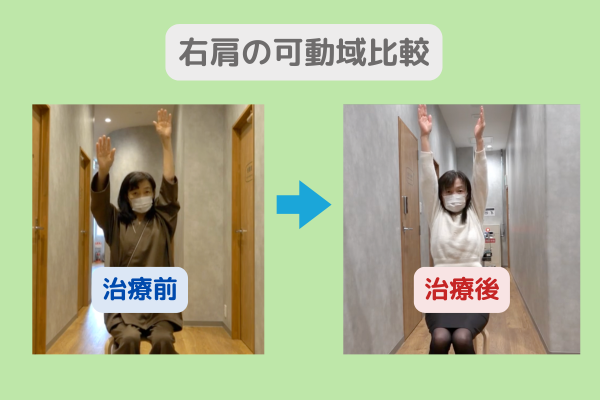 右肩腱板損傷　幹細胞治療