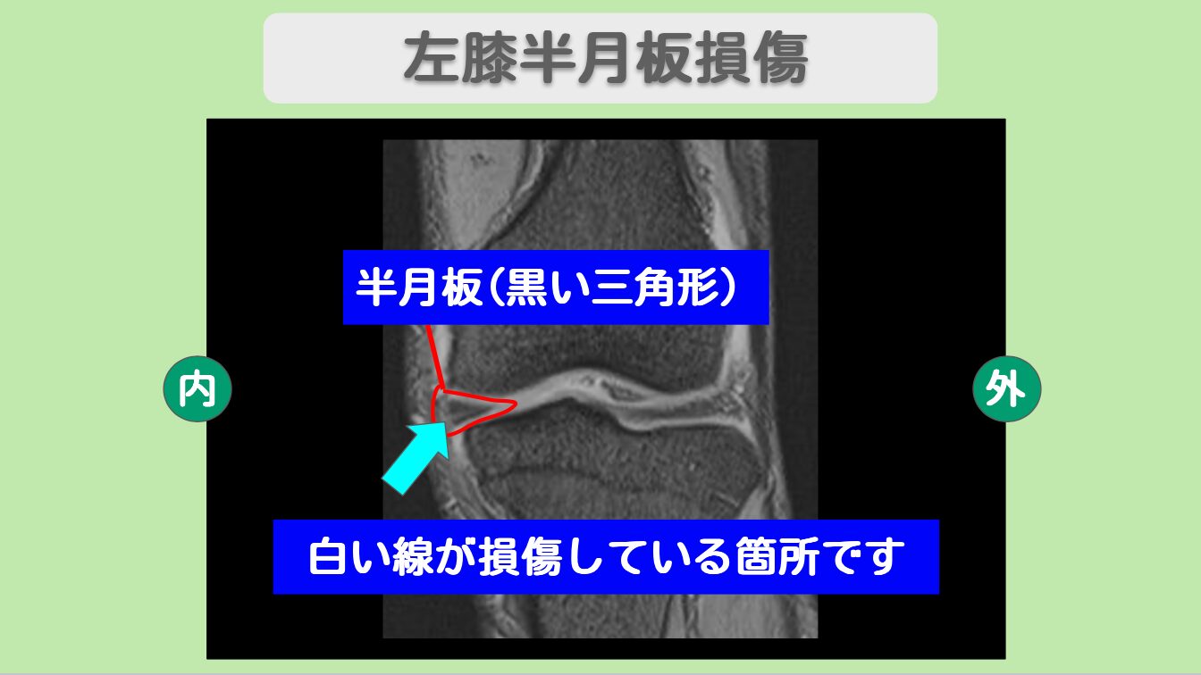 半月板損傷