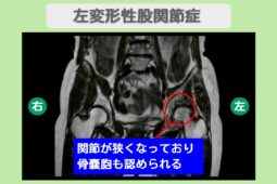 変形性股関節症