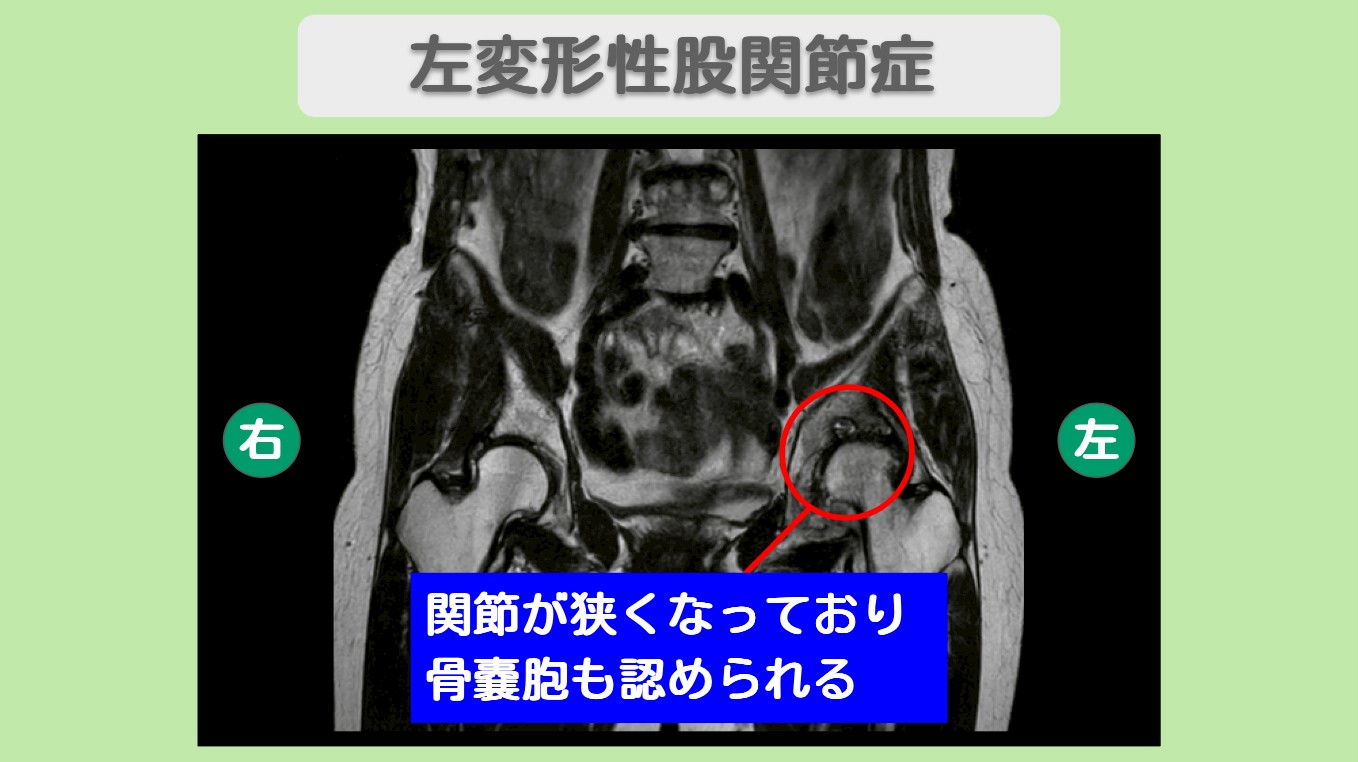 変形性股関節症