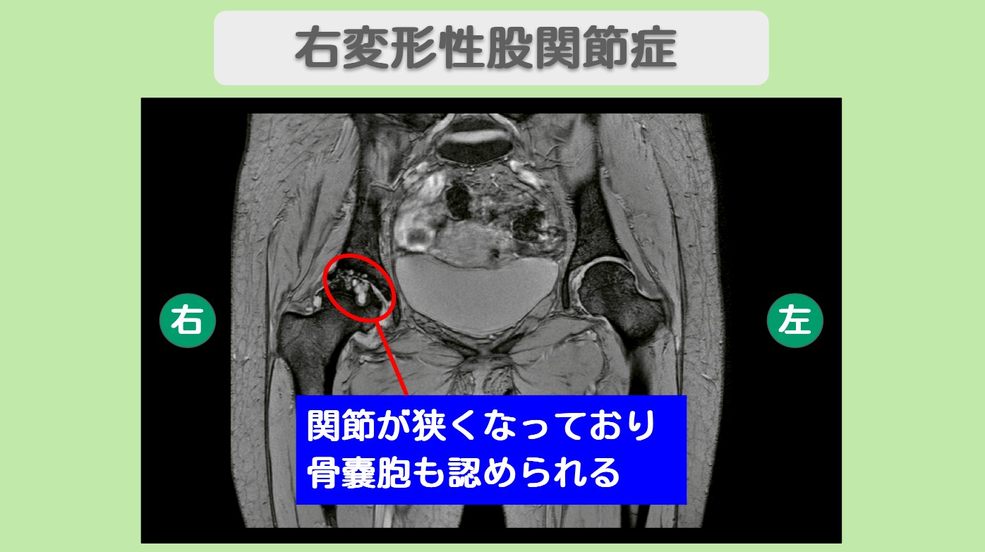 右変形性股関節症　幹細胞治療