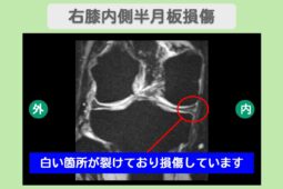右膝内側半月板損傷　幹細胞治療