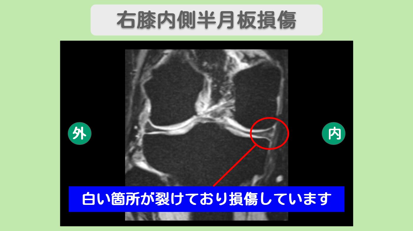 右膝内側半月板損傷　幹細胞治療
