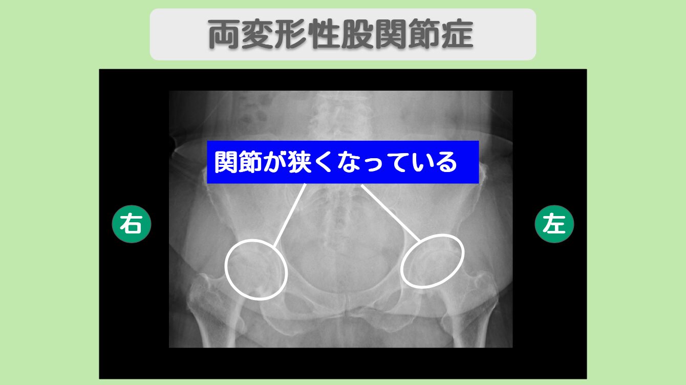両変形性股関節症　幹細胞治療