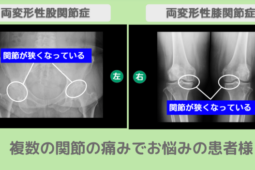 両変形性股関節症・両変形性膝関節症　幹細胞治療