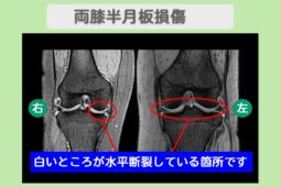両膝半月板損傷　幹細胞治療