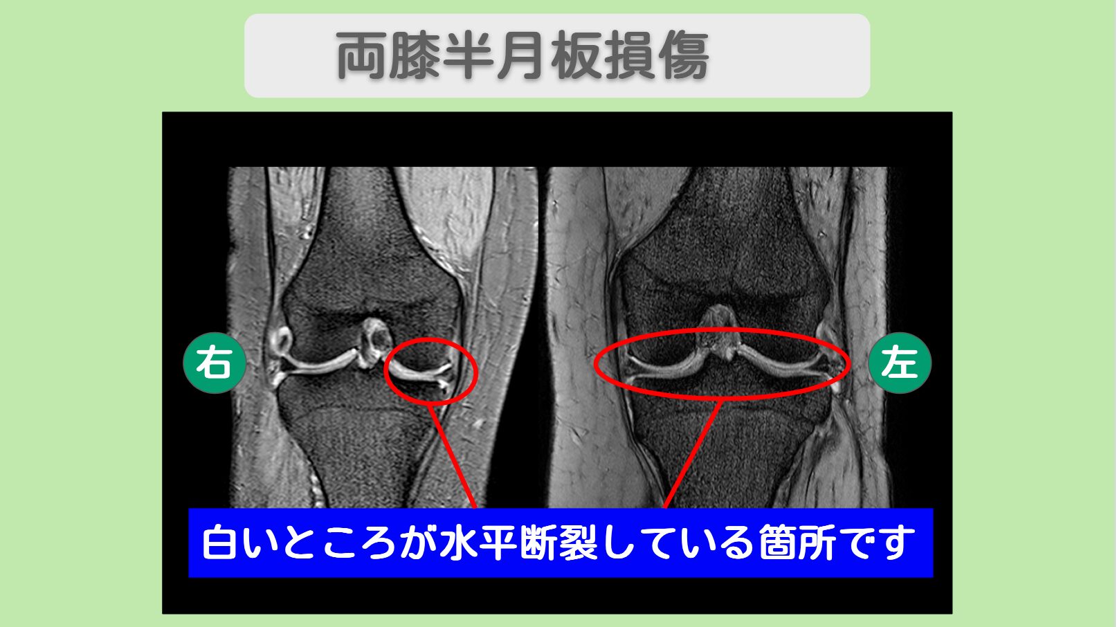 両膝半月板損傷 幹細胞治療