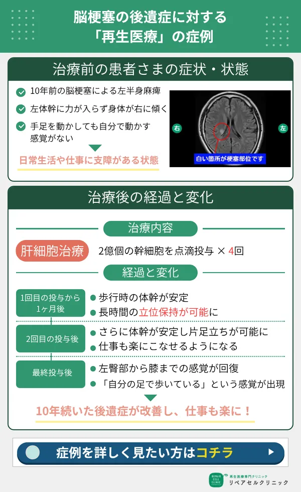 脳梗塞の後遺症に対する幹細胞治療の症例
