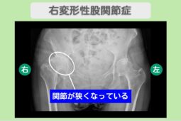 右変形性股関節症　幹細胞治療