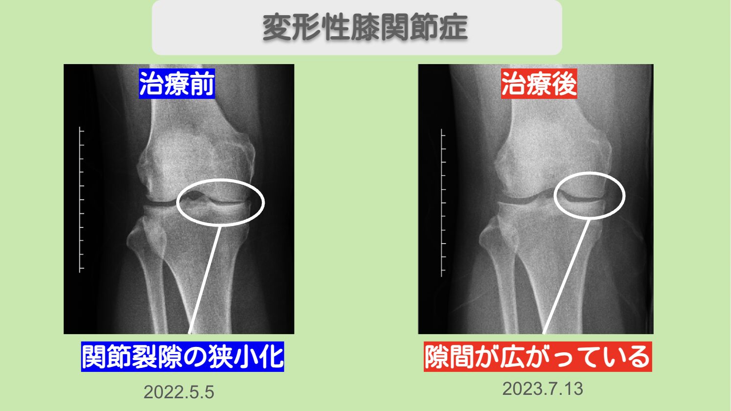 両変形性膝関節症　幹細胞治療