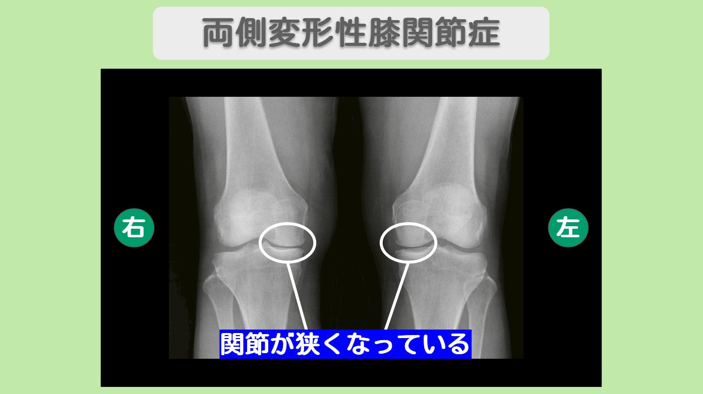 両変形性膝関節症　幹細胞治療