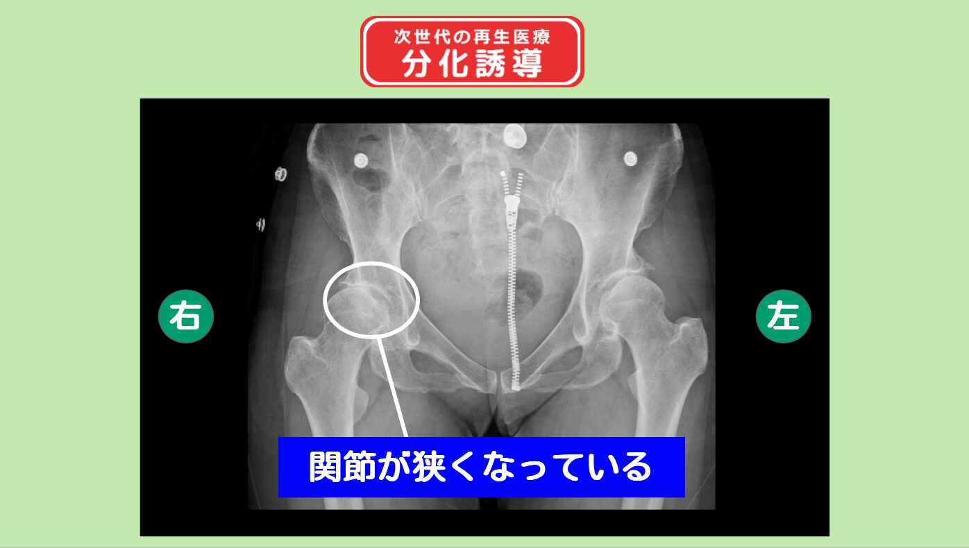 分化誘導　変形性股関節症
