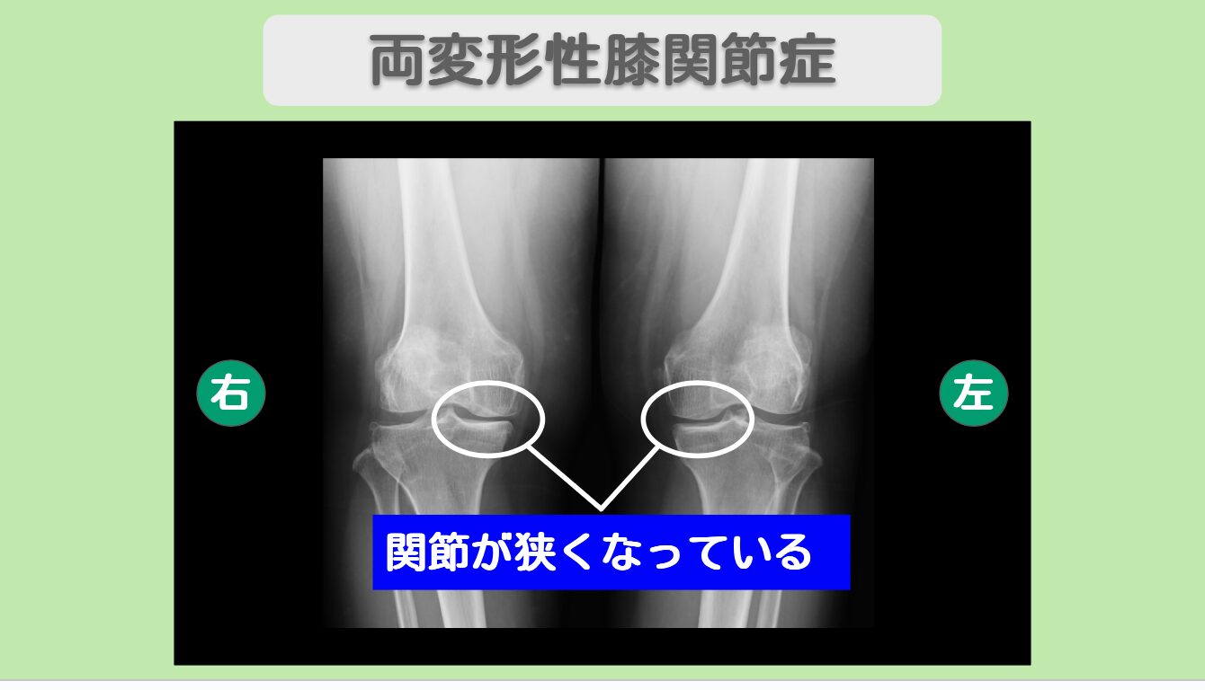両変形性膝関節症　幹細胞治療