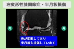 左変形性膝関節症・左半月板損傷　幹細胞治療