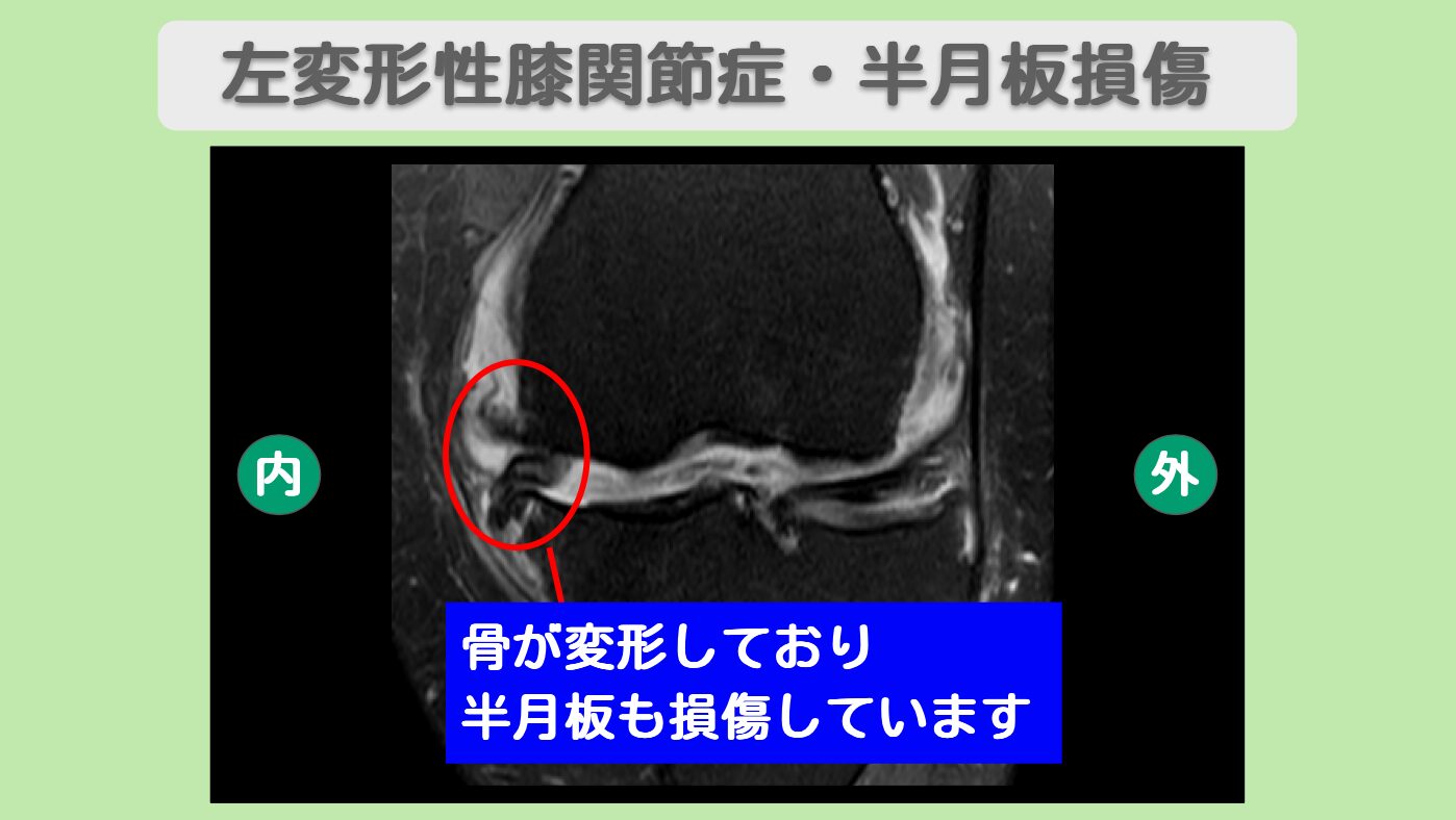 左変形性膝関節症・左半月板損傷 幹細胞治療