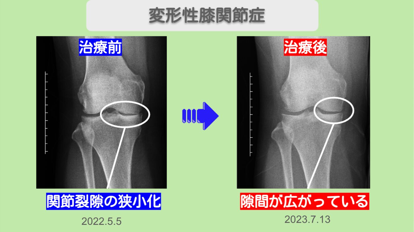 変形性膝関節症ビフォー アフター