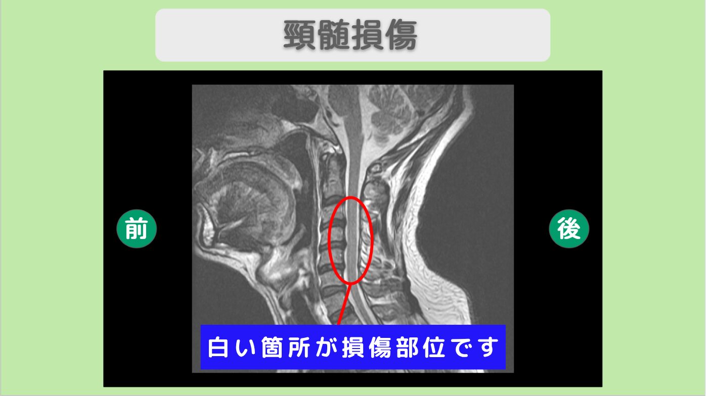 頚髄損傷　幹細胞治療