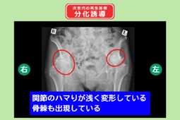 両変形性股関節症(臼蓋形成不全) 分化誘導　幹細胞治療