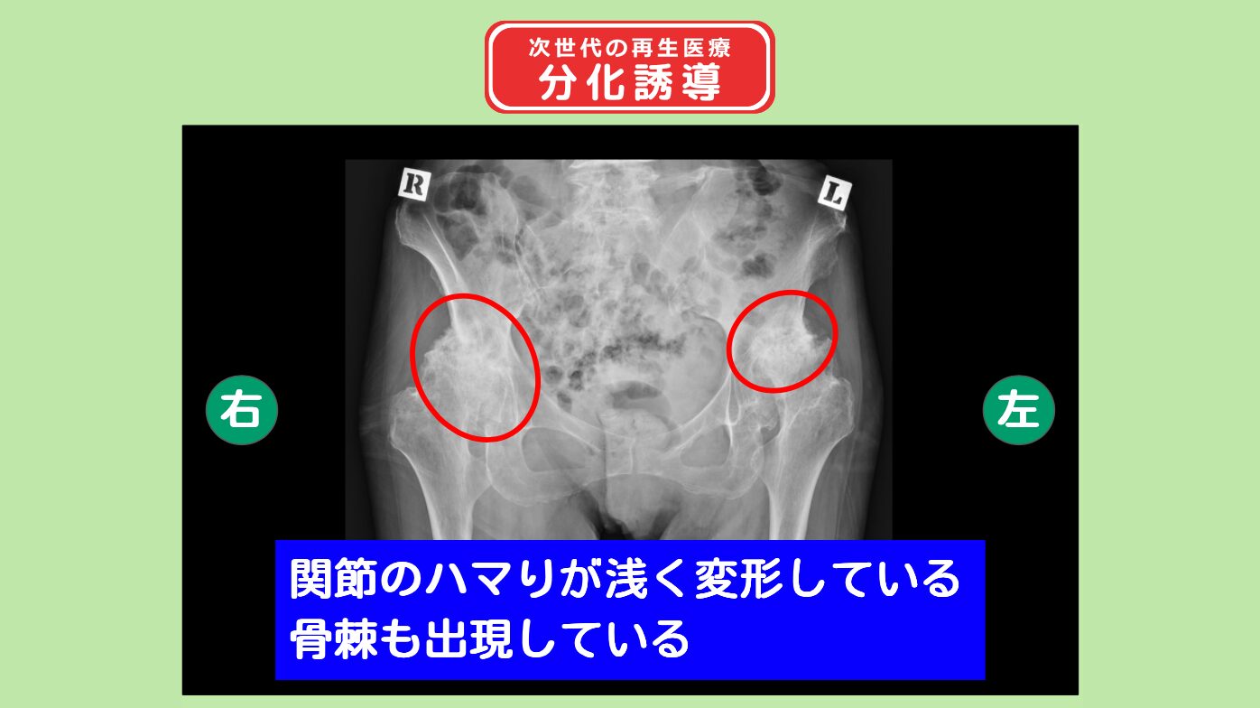 両変形性股関節症(臼蓋形成不全) 分化誘導 幹細胞治療