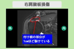 右肩腱板損傷　幹細胞治療