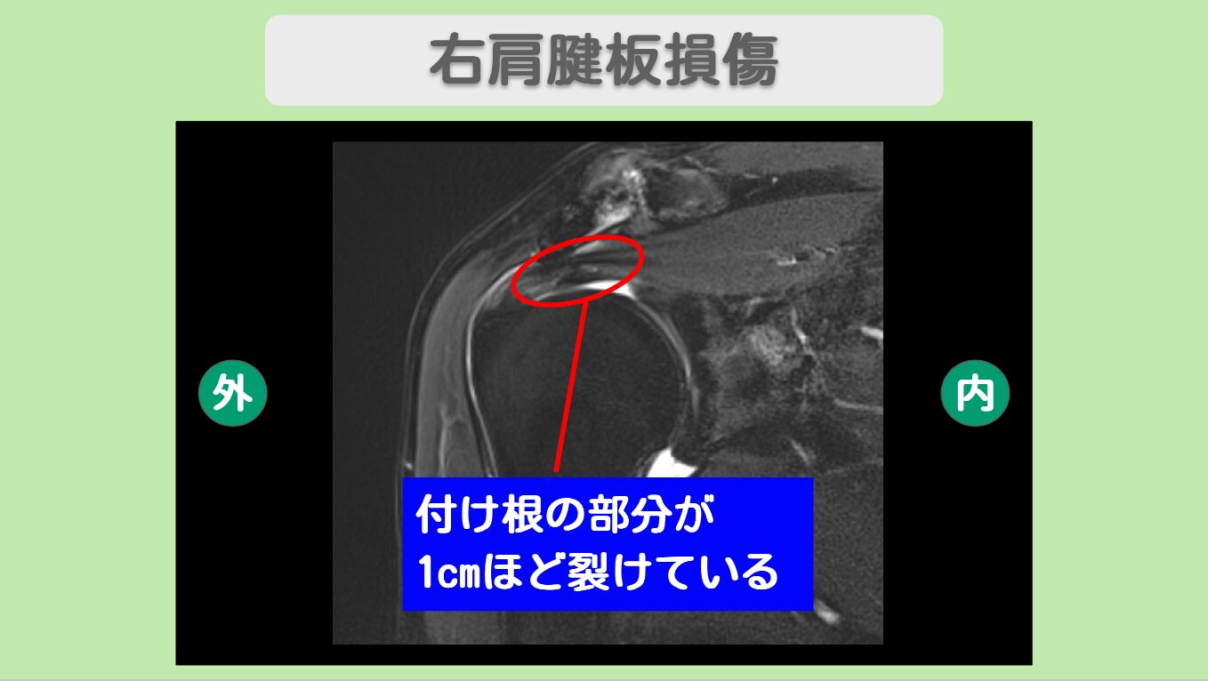 右肩腱板損傷 幹細胞治療