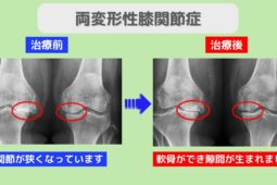 両変形性膝関節症