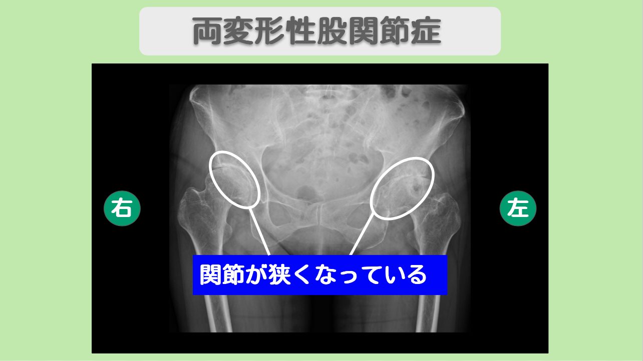 両変形性股関節症