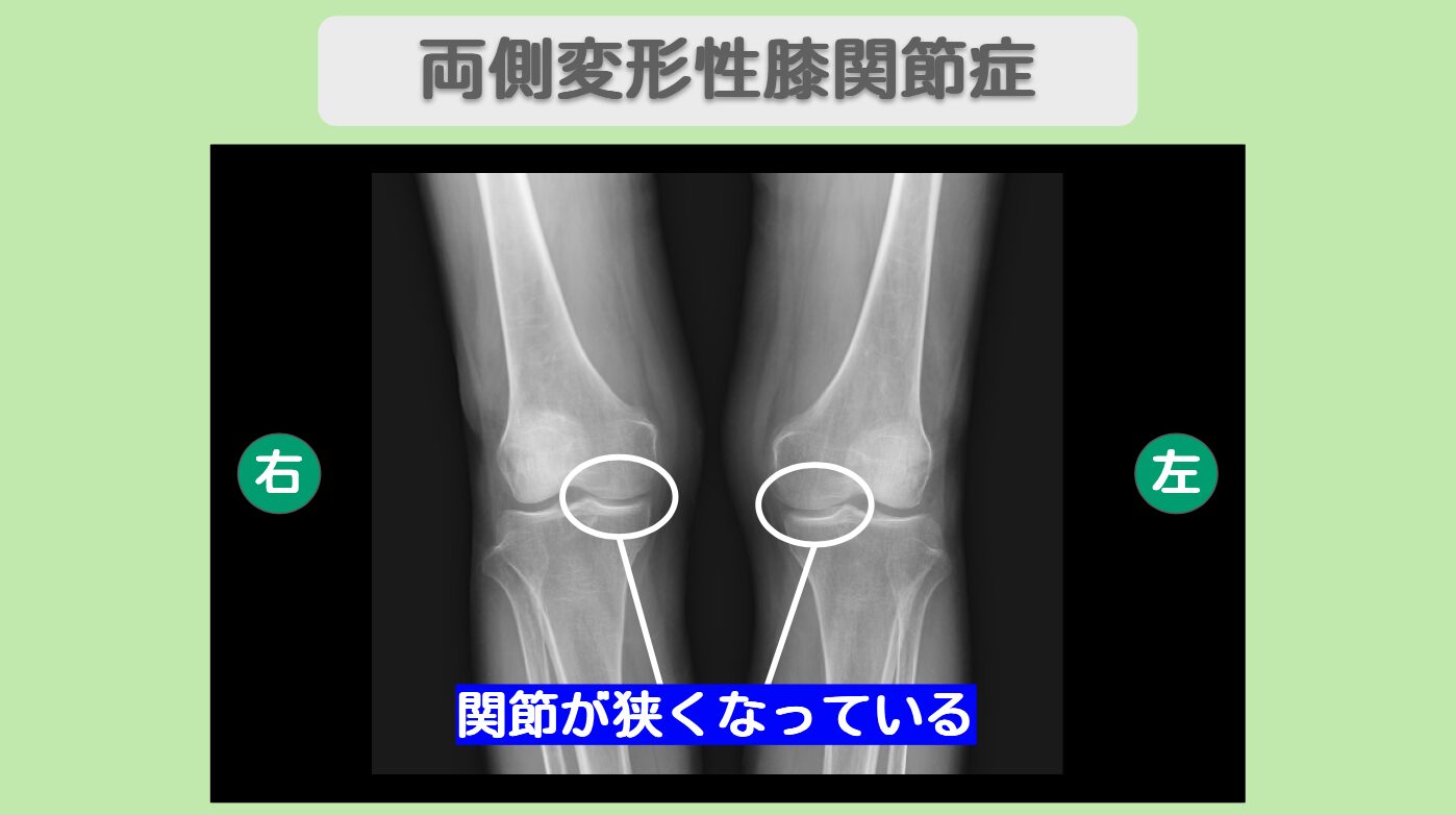変形性膝関節症