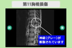 頚髄損傷　