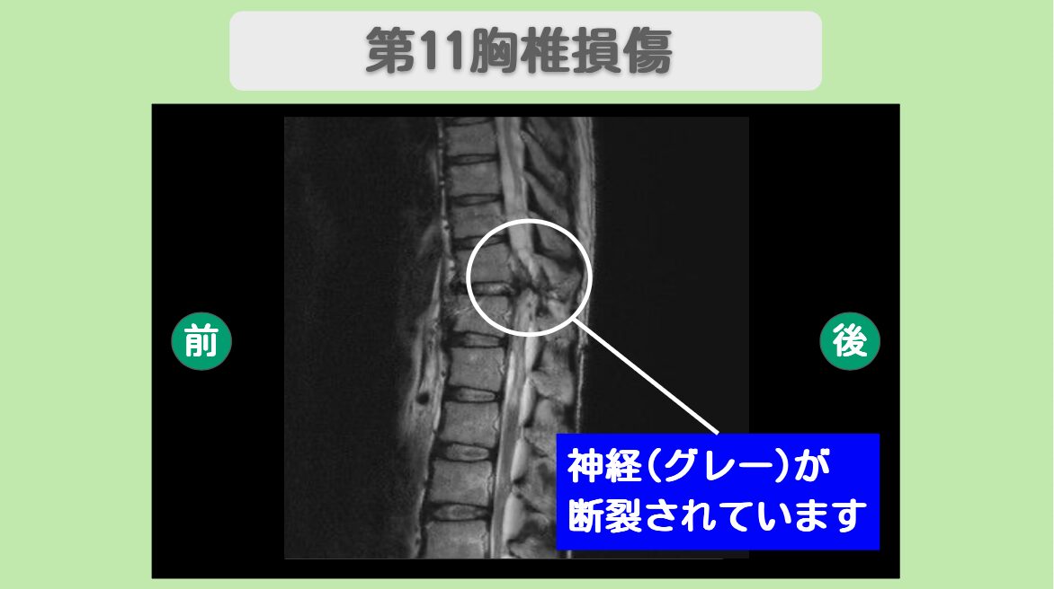 頚髄損傷