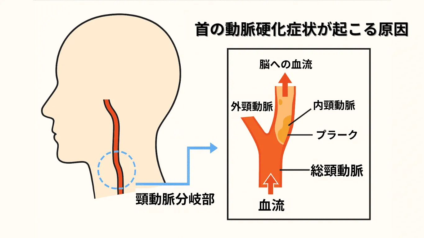 首の動脈硬化症状が起こる原因