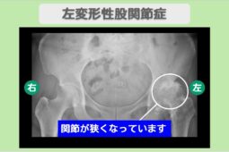 左変形性股関節症　幹細胞治療