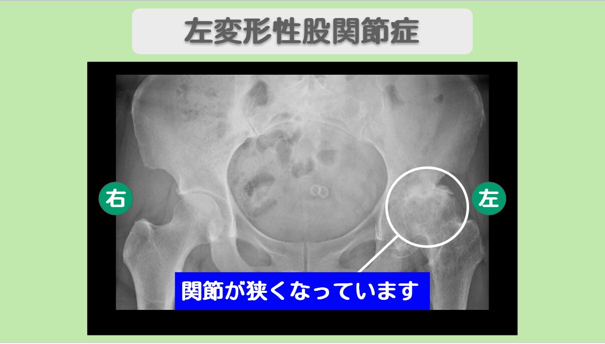 左変形性股関節症　幹細胞治療