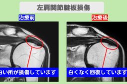 左肩腱板損傷　