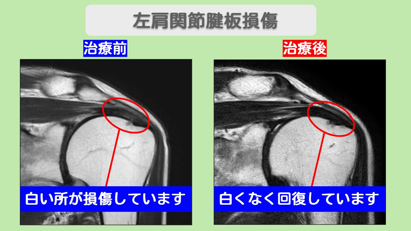 左肩腱板損傷　