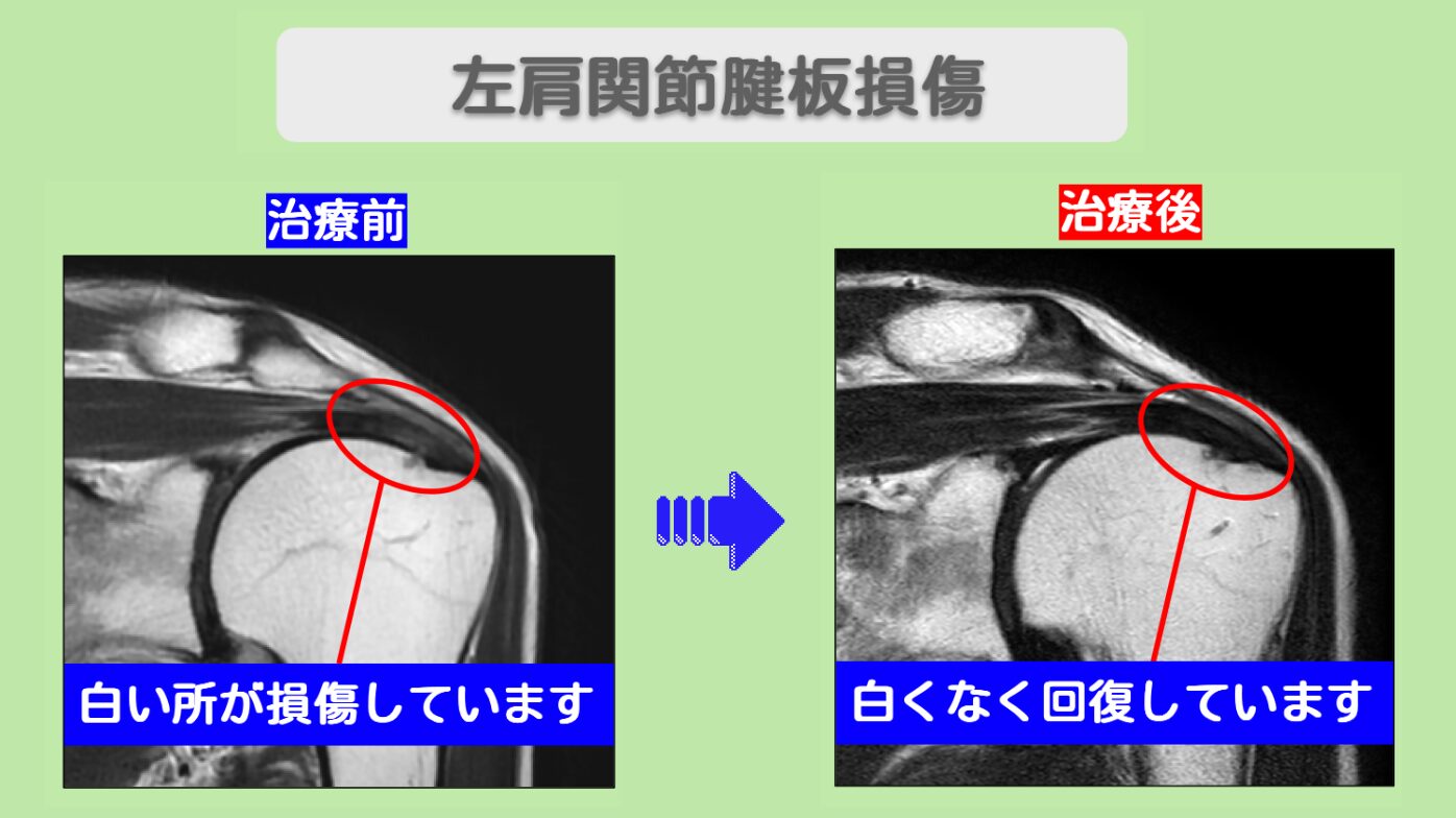 ベストセラー MRIで腱板損傷の回復を確認、痛みはゼロに！左肩腱板損傷 70代 健康・医学