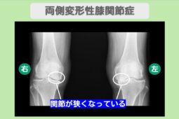 両変形性膝関節症