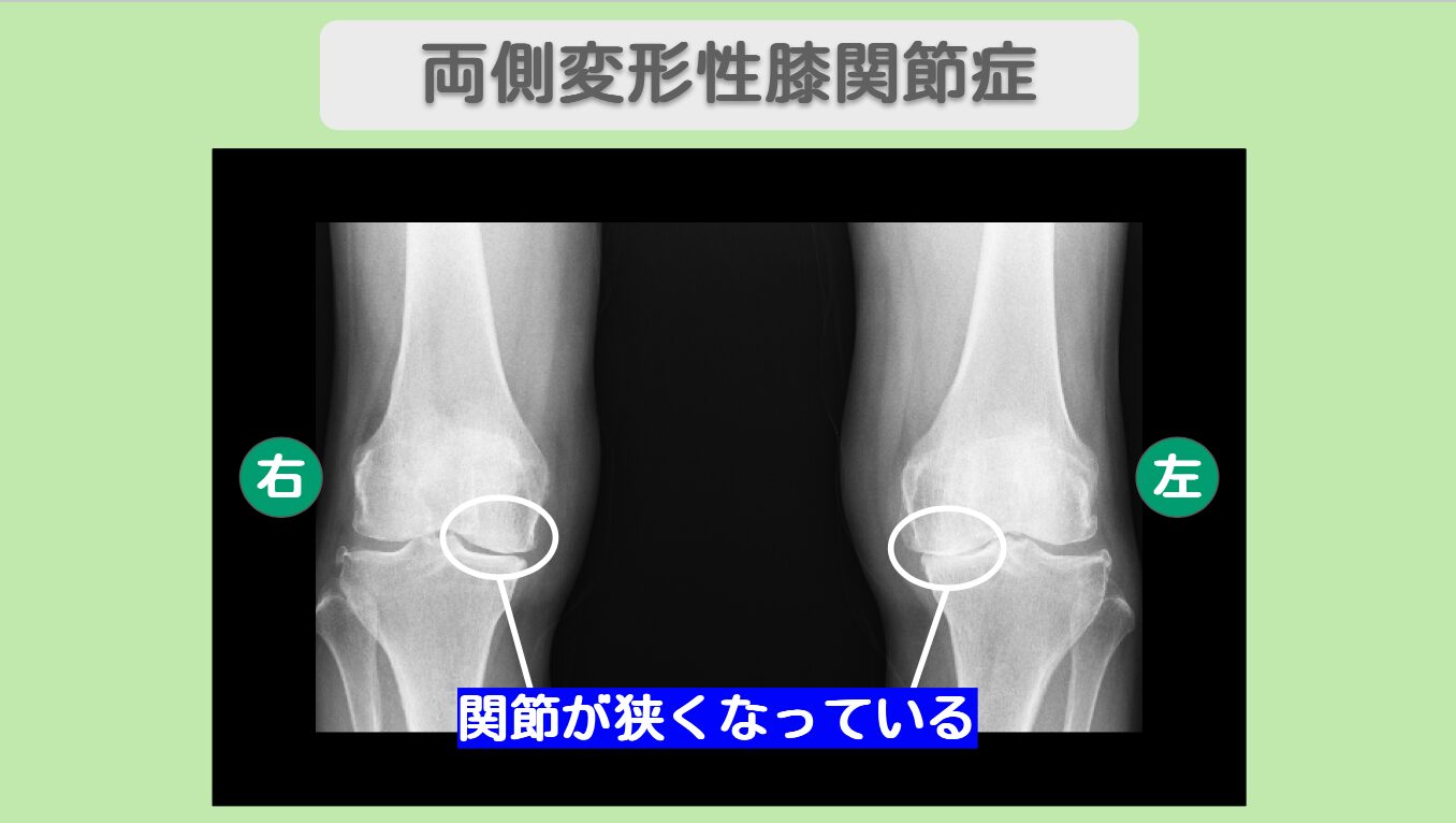 両変形性膝関節症