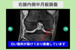 右膝内側半月板損傷